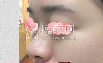 成都心悦容医院徐航医生做的肋软骨鼻部手术