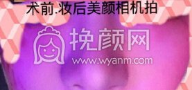 成都心悦容医院徐航医生做的肋软骨鼻部手术