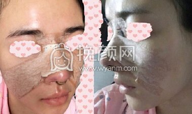 成都心悦容医院徐航医生做的肋软骨鼻部手术
