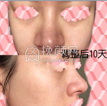 成都心悦容医院徐航医生做的肋软骨鼻部手术