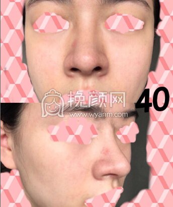 成都心悦容医院徐航医生做的肋软骨鼻部手术