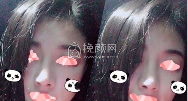 成都心悦容医院徐航医生做的肋软骨鼻部手术