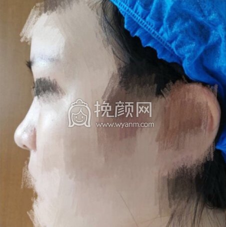 南京克拉美医院朱海波医生做的鼻部手术手术