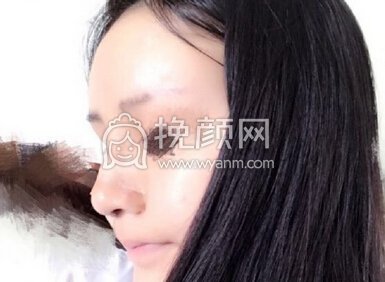 南京克拉美医院朱海波医生做的鼻部手术手术