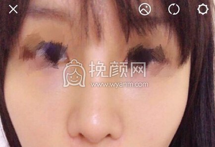 南京克拉美医院朱海波医生做的鼻部手术手术