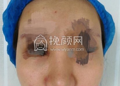 南京克拉美医院朱海波医生做的鼻部手术手术