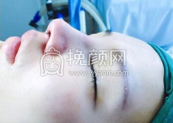 南京克拉美医院朱海波医生做的鼻部手术手术
