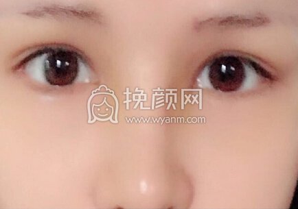 南京克拉美医院朱海波医生做的鼻部手术手术