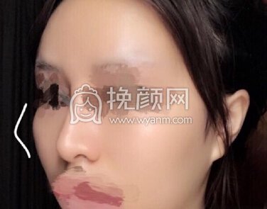 南京克拉美医院朱海波医生做的鼻部手术手术