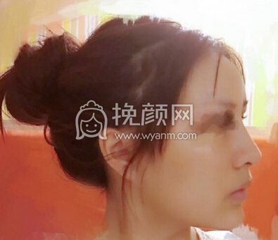 南京克拉美医院朱海波医生做的鼻部手术手术