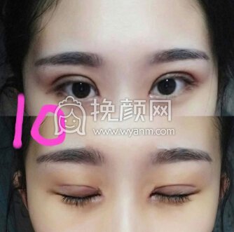 邯郸曲胜整形医院曲院长全切加内眼角