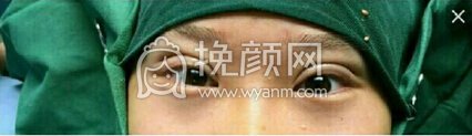 江西省中医院简雪平医生全切双眼皮+去脂去皮
