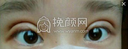 江西省中医院简雪平医生全切双眼皮+去脂去皮
