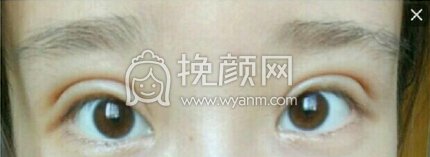 江西省中医院简雪平医生全切双眼皮+去脂去皮