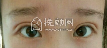 江西省中医院简雪平医生全切双眼皮+去脂去皮