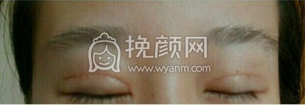 江西省中医院简雪平医生全切双眼皮+去脂去皮