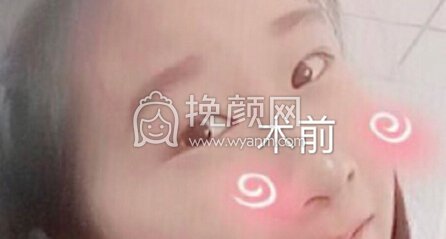 江西省中医院简雪平医生全切双眼皮+去脂去皮