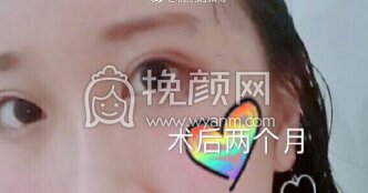 江西省中医院简雪平医生全切双眼皮+去脂去皮