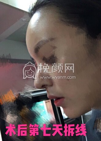 北医三院安阳全肋骨鼻部手术+全脸脂肪填充