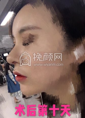 北医三院安阳全肋骨鼻部手术+全脸脂肪填充