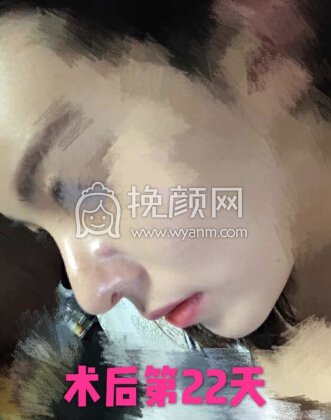 北医三院安阳全肋骨鼻部手术+全脸脂肪填充