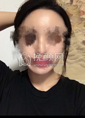 北医三院安阳全肋骨鼻部手术+全脸脂肪填充