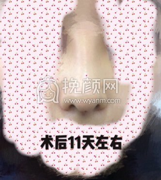 成都西婵绍文辉做的硅胶隆鼻+耳软骨鼻中隔