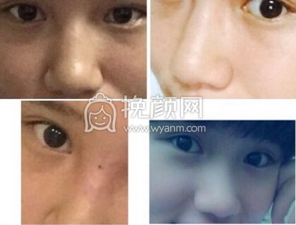 重庆市精美整形医院田永华医生硅胶鼻部手术