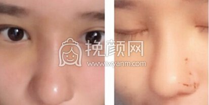 重庆市精美整形医院田永华医生硅胶鼻部手术
