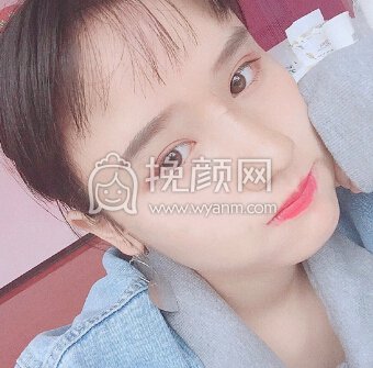 重庆市精美整形医院田永华医生硅胶鼻部手术