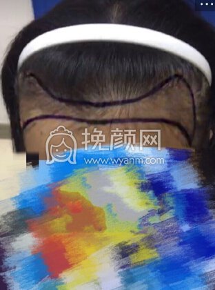 南宁贞韩植发,发际线+双侧额角