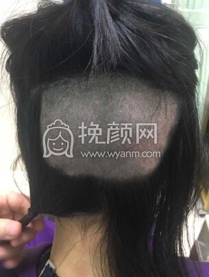南宁贞韩植发,发际线+双侧额角
