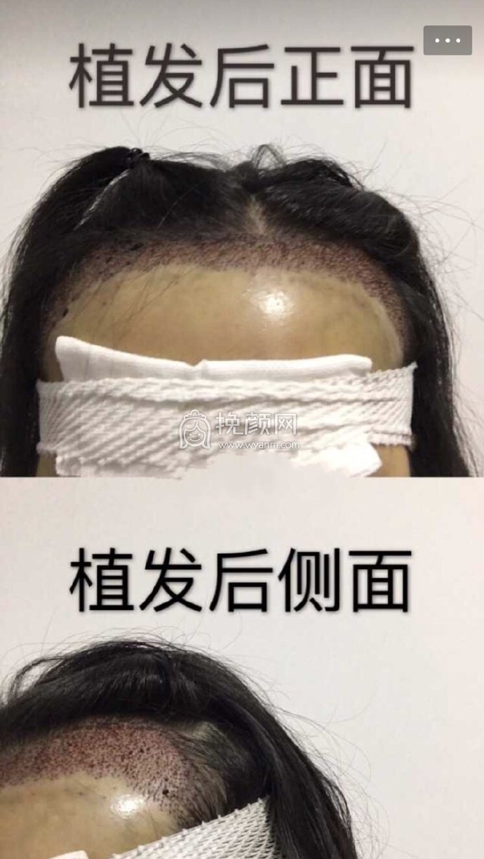 南宁贞韩植发,发际线+双侧额角