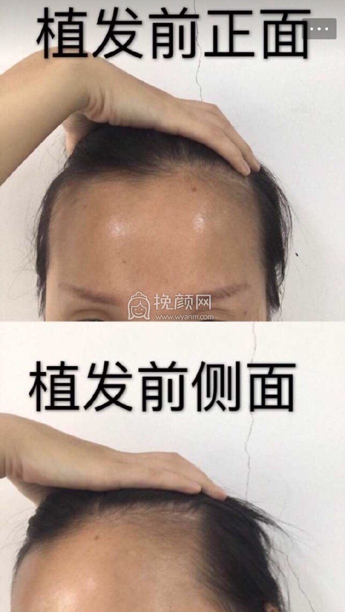 南宁贞韩植发,发际线+双侧额角