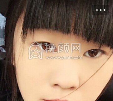 上海九院王梓做的双眼皮成行术+去皮去脂