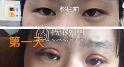 上海九院王梓做的双眼皮成行术+去皮去脂