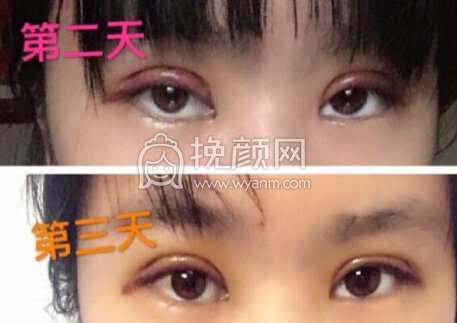 上海九院王梓做的双眼皮成行术+去皮去脂