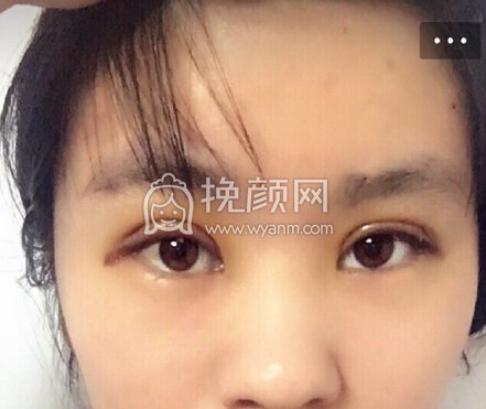 上海九院王梓做的双眼皮成行术+去皮去脂