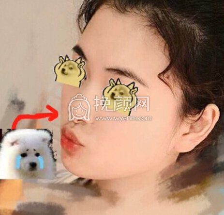 俺滴鼻小柱是缩好还是不缩好?