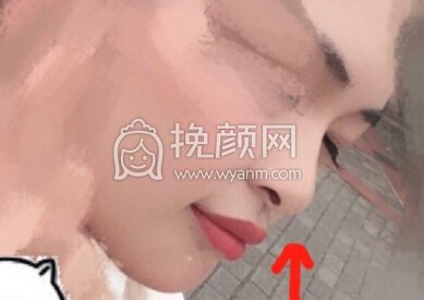 俺滴鼻小柱是缩好还是不缩好?