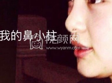 俺滴鼻小柱是缩好还是不缩好?