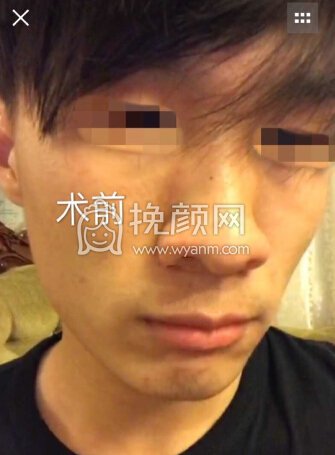 深圳李信锋鼻整形医院李信锋医生做的鼻部手术