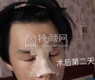 深圳李信锋鼻整形医院李信锋医生做的鼻部手术