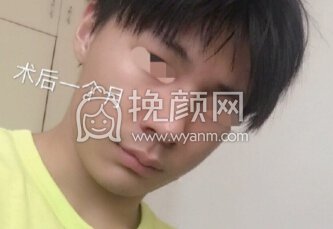 深圳李信锋鼻整形医院李信锋医生做的鼻部手术