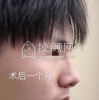 深圳李信锋鼻整形医院李信锋医生做的鼻部手术