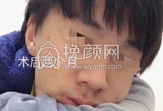 深圳李信锋鼻整形医院李信锋医生做的鼻部手术
