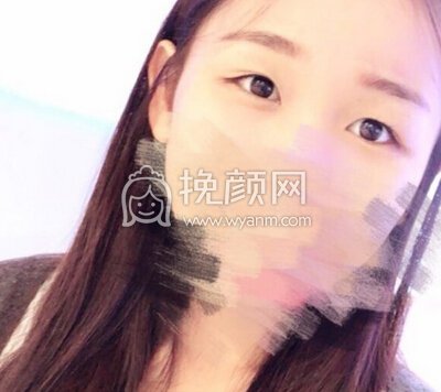 想做双眼皮父母不同意,朋友也说别做,求建议