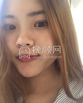 我基础差尤其是鼻子,面诊了和军美