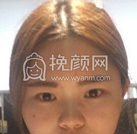 我基础差尤其是鼻子,面诊了和军美