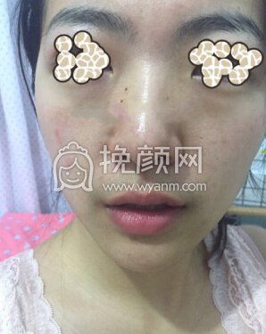 哈尔滨医大四院张医生做的果酸换肤